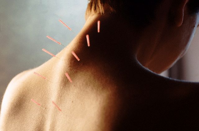 A Person’s Back With Multiple Acupuncture Needles Inserted